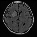 脳梗塞 MRI画像